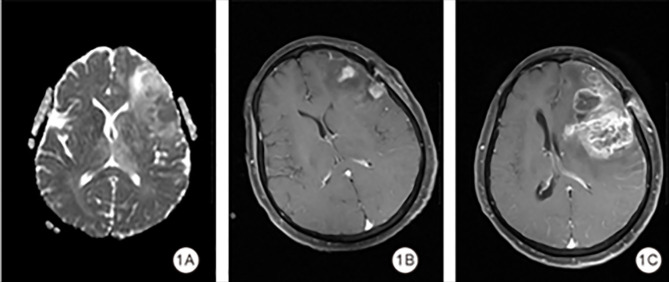 The Predictive Value of ADC Values, Degree of Edema and the Systemic Immune-Inflammation Index for Early Postoperative Recurrence in High-Grade Gliomas.