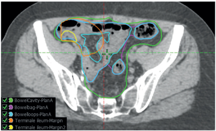 Predictors of acute and late diarrhea in the treatment of anal cancer with concurrent chemoradiotherapy.