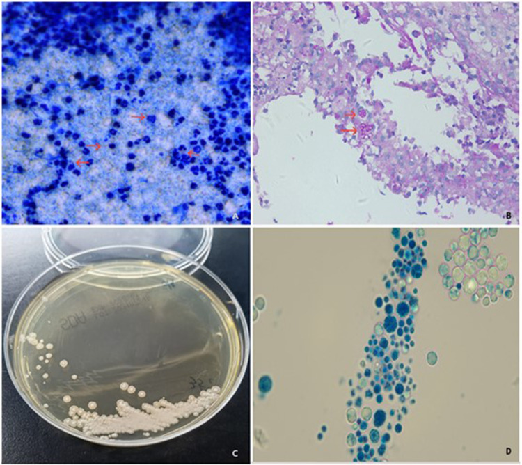 Recurrent Subcutaneous Abscess from Co-Infection with <i>Prototheca wickerhamii</i> and <i>Mycobacterium haemophilum</i>: mNGS Misdiagnosis as Leprosy.