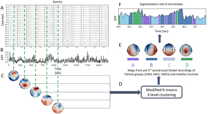 Dynamics of EEG Microstates Change Across the Spectrum of Disorders of Consciousness.