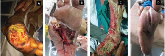 Role of Biomarkers in Diabetic Foot Osteomyelitis.