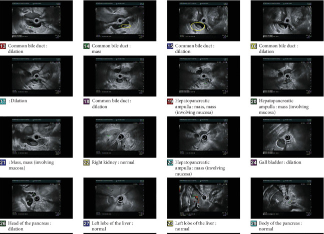Defying the Prognostic Odds: A Case Report of Unexpected Complete Remission of Metastatic Ampullary Carcinoma With Palliative Chemotherapy.