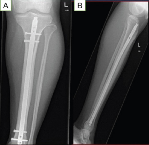 Diagnostic Pitfalls: Anterior Tibial Stress Fracture in a Professional Football Player - A Case Report.