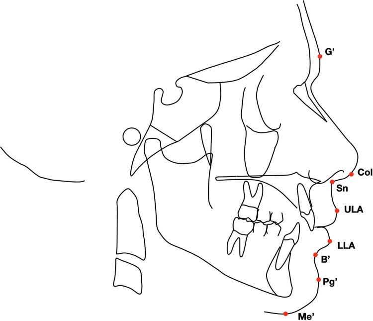 Soft tissue evaluation of functional therapy in growing patients with class II malocclusion: mandibular advancement vs. twin block-a retrospective study.