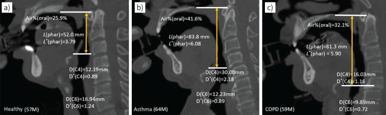 Oropharyngeal enlargement in obstructive lung disease: quantification and machine learning.