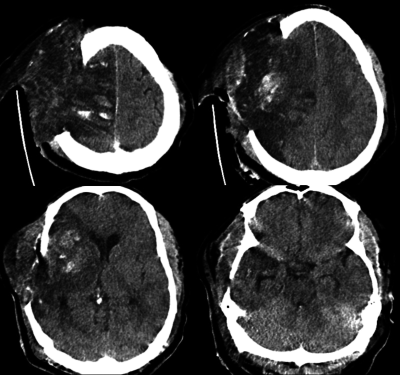Managing malignant middle cerebral artery infarction with open scalp incision and partial hemispherectomy: illustrative case.