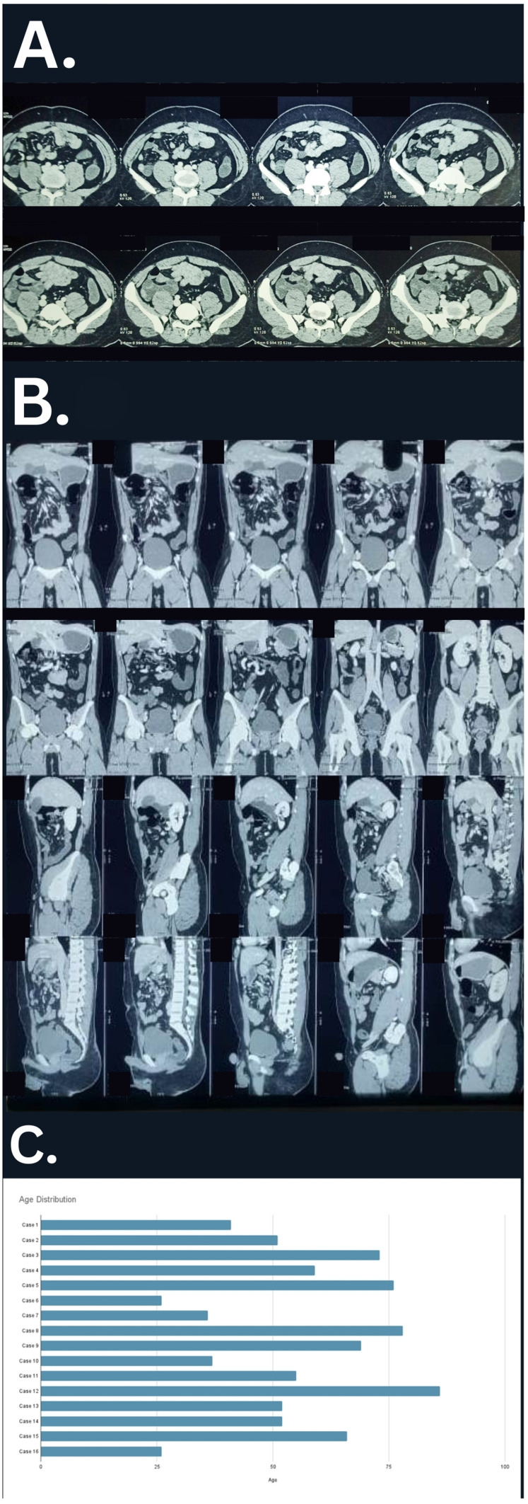 Clinical Perspective on Midgut Nonrotation in Adults: A Clinical Case Report and Review of the Literature.