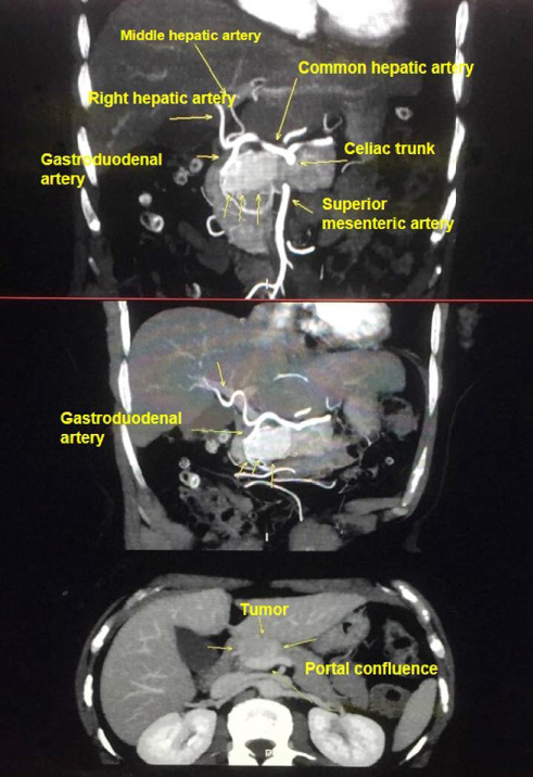 Solid Serous Cystadenoma Mimicking Neuroendocrine Tumor of the Pancreas: A Case Report.