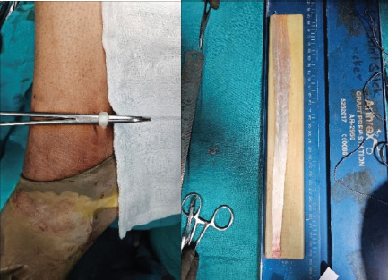 Simultaneous ACL Reconstruction and MCL Reconstruction in Patients with High BMI using Modified Lind Technique.
