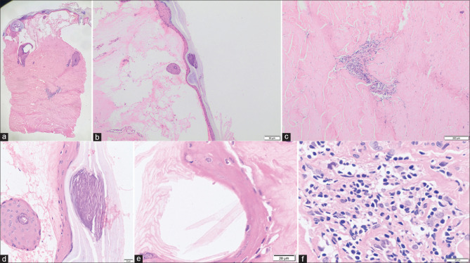 Extragenital Lichen Sclerosus - Morphea Overlap within the Same Lesion: A Rare Occurrence.