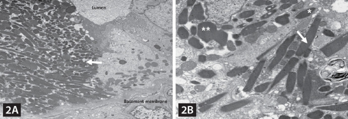 Findings suggestive of Fanconi syndrome and multiple myeloma.