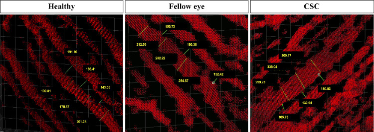 Three-Dimensional Choroidal Vessels Assessment in Fellow Eyes of Patients With Central Serous Chorioretinopathy.