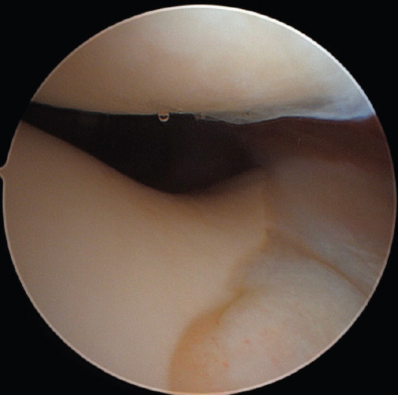 An Anomalous Attachment of the Medial Meniscus Posterior and Anterior Roots Mimicking a Bucket Handle Meniscus Tear: A Case Report and Review of the Literature.