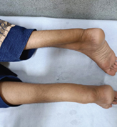 Bilateral Tendoachilles Xanthoma in a Young Female: A Rare Case Report.