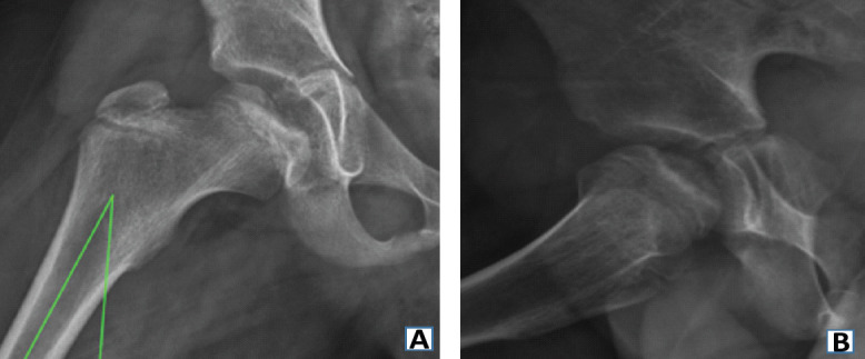 Developmental Hip Dysplasia Presenting as Bilateral Osteochondritis Dissecans Perthes-like Lesions Treated with Triple Pelvic Osteotomies: A Case Report.