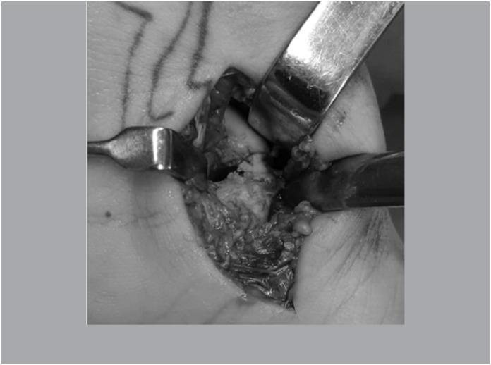 PLATE USING CANCELLOUS GRAFT VERSUS SCREW USING CANCELLOUS CORTICAL GRAFT IN THE TREATMENT OF SCAPHOID PSEUDARTHROSIS.