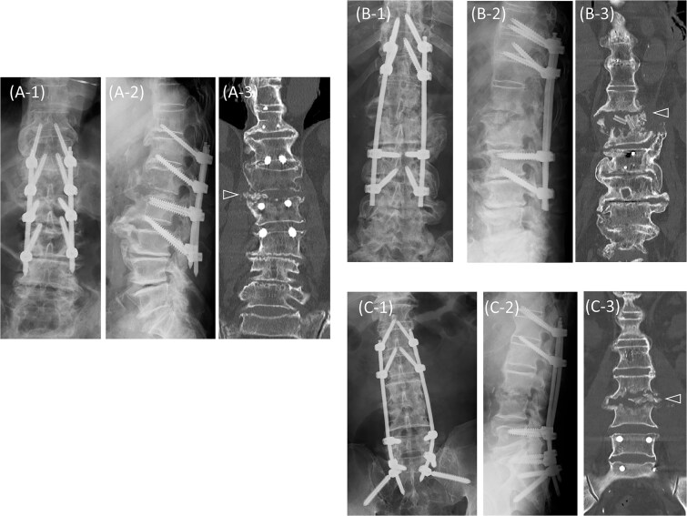 Successful treatment of pyogenic spondylitis in a non-ankylosing lesion of diffuse idiopathic skeletal hyperostosis using penetrating endplate screws: a three-case report.