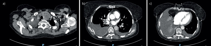 Bilateral pleural effusions, ascites and pulmonary emboli: Meigs syndrome.