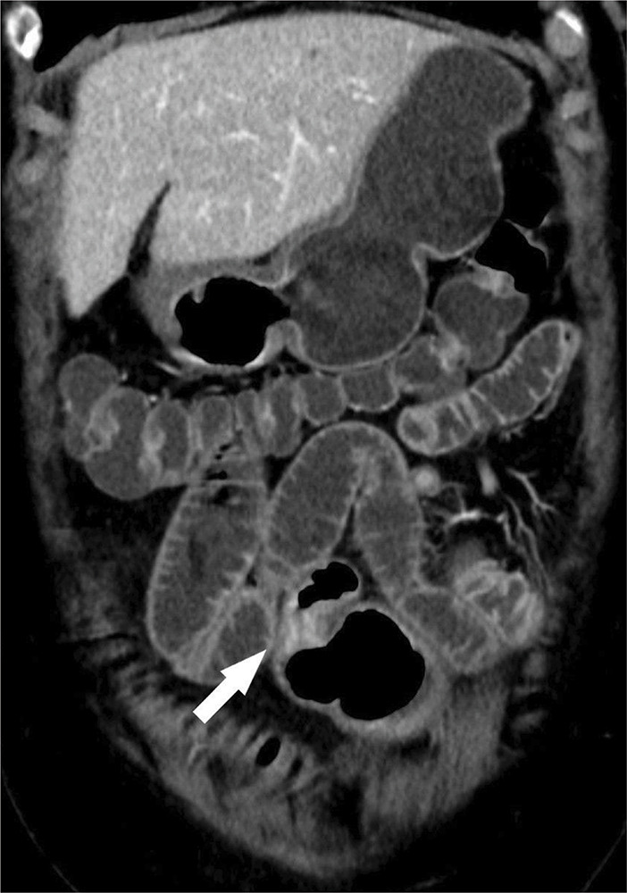 Neuroendocrine Small Bowel Tumor.