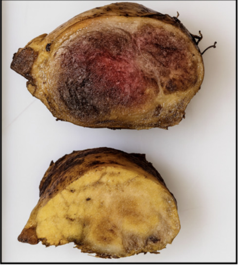 Solid Serous Cystadenoma Mimicking Neuroendocrine Tumor of the Pancreas: A Case Report.