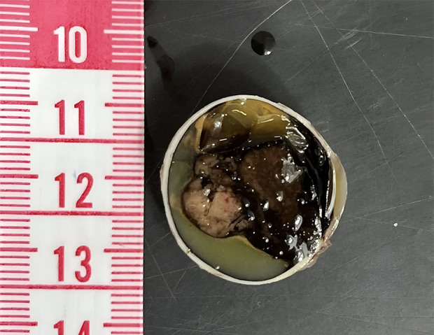 Progressive Vision Loss From Uveal Melanoma with Extraocular Extension: A Case Report.