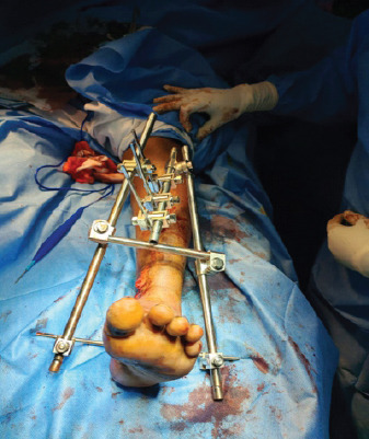 Single-Stage Hybrid Fixation of a Grade III Open, Unstable Trimalleolar Ankle Fracture with Syndesmotic Disruption and Posterior Talar Subluxation.
