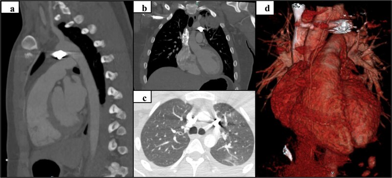 Case study: robotic foreign body removal of bullet in the aortopulmonary window.