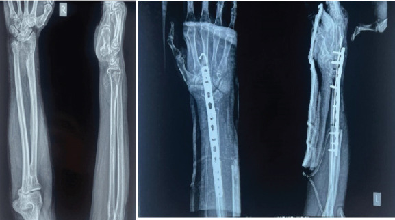 Optimizing Functional Recovery in Multi-Site Giant Cell Tumors.