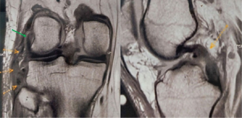 Finding the Optimal Balance - Isolated Posterolateral Corner Reconstruction with Allograft Tendon in a Combined Posterolateral Corner-Posterior Cruciate Ligament Injury: A Case Report.