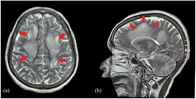 Beyond the Usual Features-Expanded Dengue Syndrome in Association With Possible Pre-existing Neurological Disease: A Case Report.