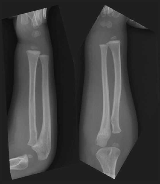 Acute Forearm Compartment Syndrome in a Toddler Caused by Hematoma without Fracture: A Case Report.