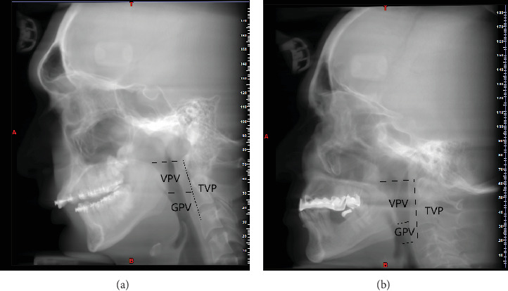 The Relation of Skeletal Malocclusion and Airway Volumes: A Cross-Sectional Study.