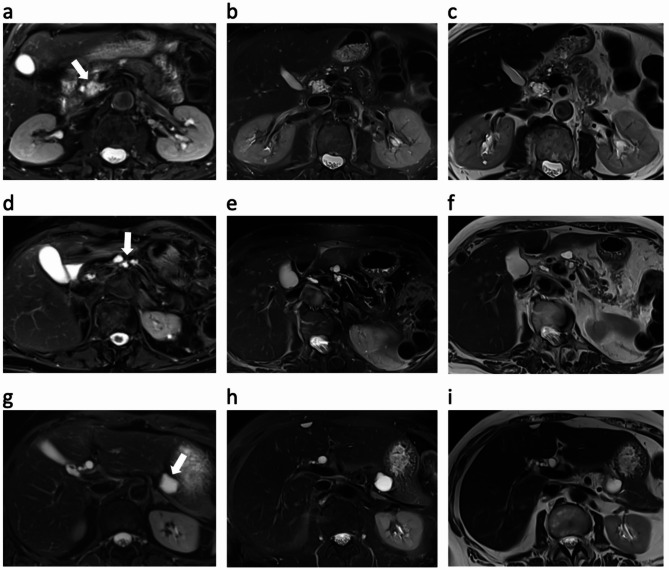 Optimized deep learning-accelerated single-breath-hold abdominal HASTE with and without fat saturation improves and accelerates abdominal imaging at 3 Tesla.