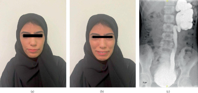 Urofacial Syndrome, an Expressive and Unmasking Sign of Voiding Dysfunction: Case Report and Review of the Literature.