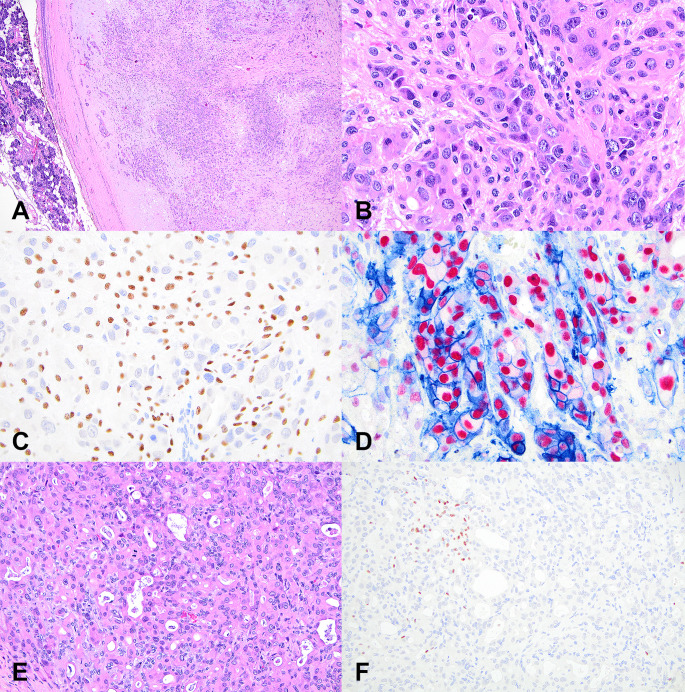 Pleomorphic Adenoma with Epithelial Atypia, Apocrine Metaplasia, and/or In situ/Intracapsular Salivary Duct Carcinoma Are Indolent Lesions with Good Prognosis: A Proposal for Unified Nomenclature and Clinical Observation.