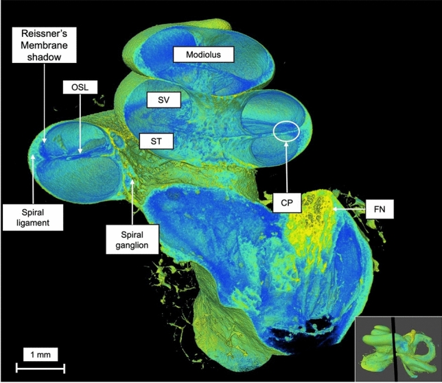 Volume rendering technique and high-resolution microCT: 3D exploration of the cochlear anatomy.