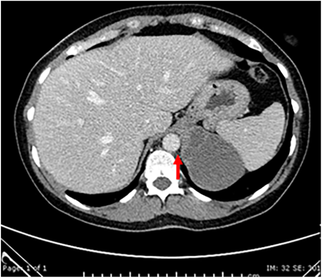 Retroperitoneal bronchogenic cyst masquerading as an adrenal incidentaloma.