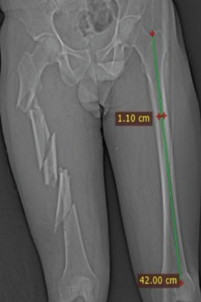 Triple-Segmental Shaft Femur Fracture: A Case Report.