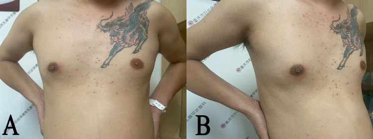 Surgical Management of Recurrent Plasma Cell Mastitis in a Male Patient: A Case Report.