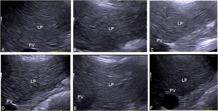 Ultrasound measurements of croup fat thickness and liver echogenicity as indicators for lipomobilization in donkeys (Equus Africanus asinus) with fasting-induced hyperlipidemia.