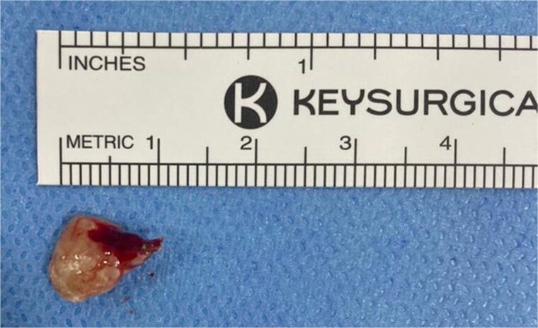 Unusual migration of a tooth root into the ethmoid sinus after dental extraction: a case report and literature review.