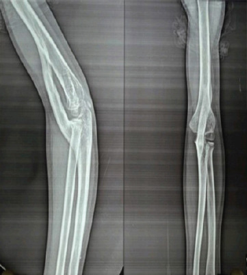 Humeroulnar Bridging Myositis Ossificans Traumatica: A Case Report.