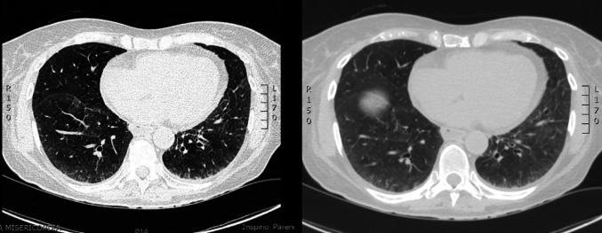 Simultaneous onset of systemic sclerosis and light chain amyloidosis: the first report of a case report and review of the literature.