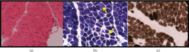 Hypotonia, Ataxia, Developmental Delay and Tooth Enamel Defect Syndrome (HADDTS) due to a Heterozygous de Novo Missense Variant in <i>CTBP1</i> Identified via Whole Genome Sequencing.