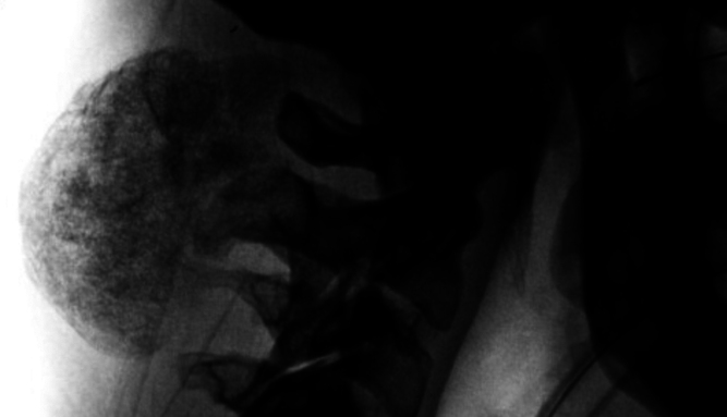 Extraskeletal para-articular osteochondroma adjacent to the cervical spine: illustrative case.