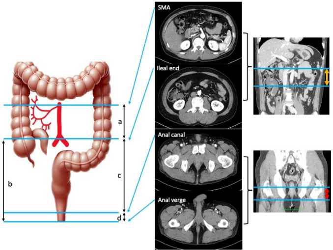 Visceral obesity as a predictor of ileal pouch reachability in ulcerative colitis: A prospective single-center study.