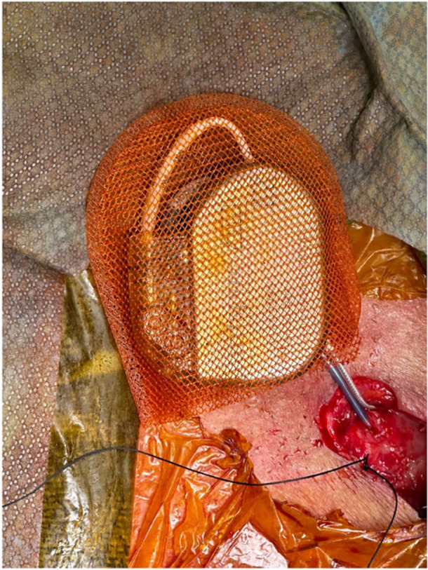 Hypoglossal Nerve Stimulator Lead Extrusion: Successful Management and Reimplantation.