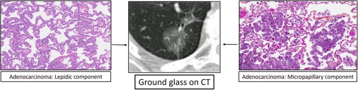 There Is More Than Meets the Eye With Ground Glass Nodules: Is It Too Early to Adopt Sublobar Resection as Standard of Care for Early Stage Lung Adenocarcinoma?