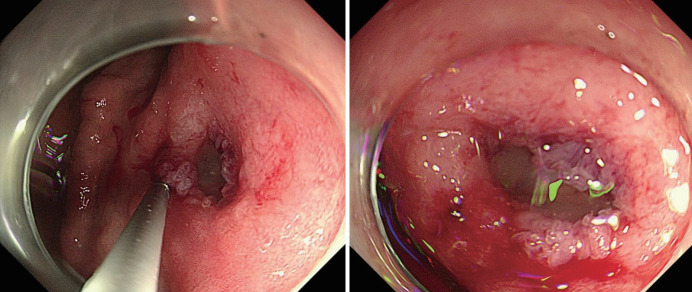 Atypical Gastric Lesion Revealing Underlying Pancreatic Cancer With Direct Invasion.