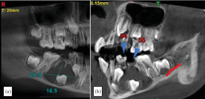 Successful Preservation of a Developing Unerupted Tooth Associated With Dentigerous Cyst in a Child: A Case Report.